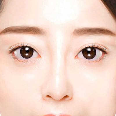 눈매교정비절개수술3교정