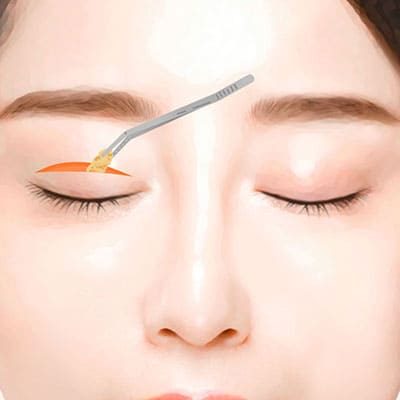 눈매교정절개수술1제거