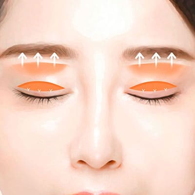눈매교정절개수술2조절