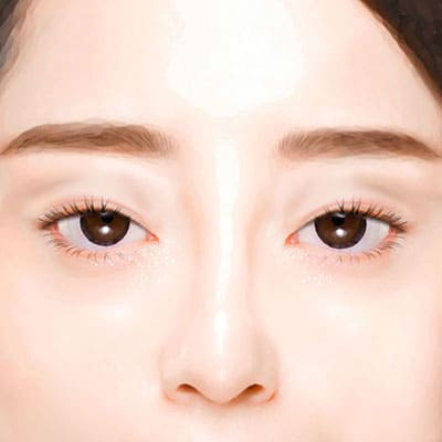 눈꺼풀지방이식수술방법1진단