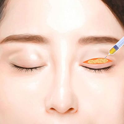 눈꺼풀지방이식수술방법3지방이식