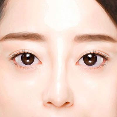 눈꺼풀지방이식수술방법4개선