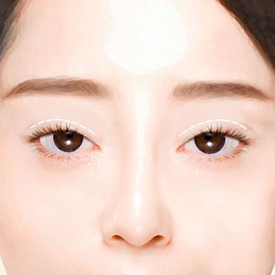 짝눈비대칭쌍꺼풀재수술2계획