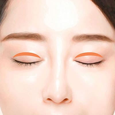 짝눈비대칭쌍꺼풀재수술3재수술