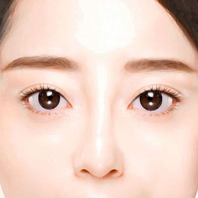 짝눈비대칭쌍꺼풀재수술4교정