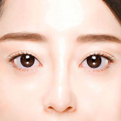 돌출눈함몰눈수술방법