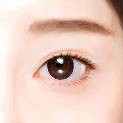 높은쌍꺼풀수술방법4완성