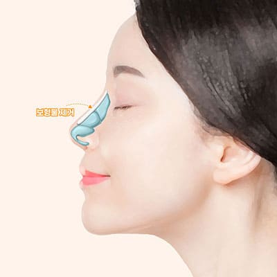 보형물돌출코재수술방법2제거