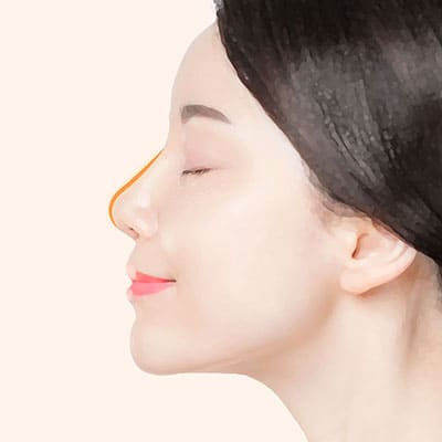보형물돌출코재수술방법4개선