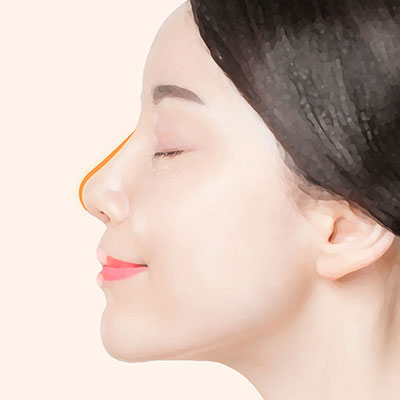기증늑연골코재수술방법4개선