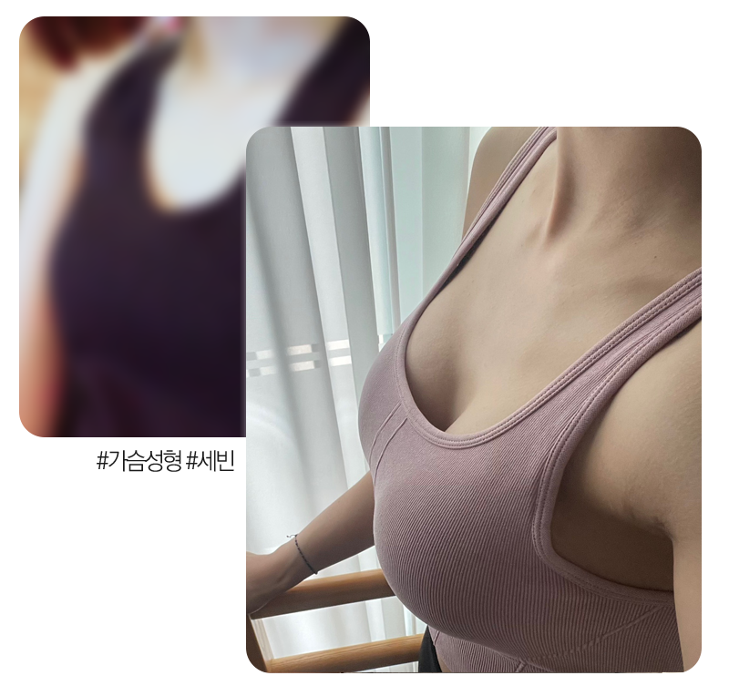 가슴성형전후셀피2세빈