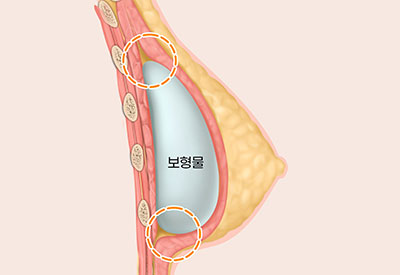 가슴확대수술방법1근육아래삽입법
