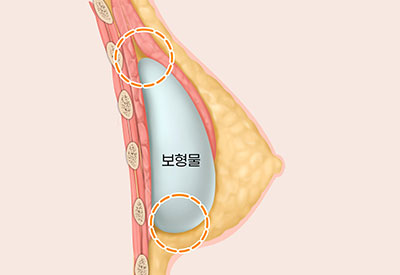 가슴확대수술방법3듀얼플레인이중평면삽입법