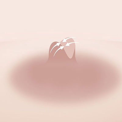 유두축소수술방법3
