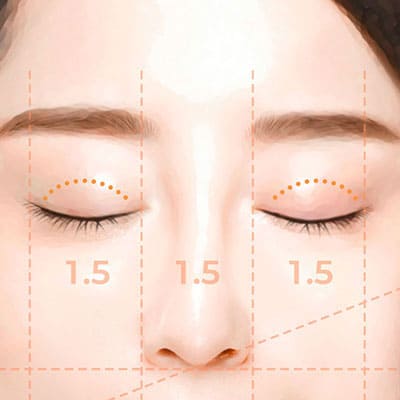 절개쌍꺼풀수술방법1디자인