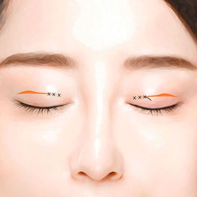 절개쌍꺼풀수술방법3봉합