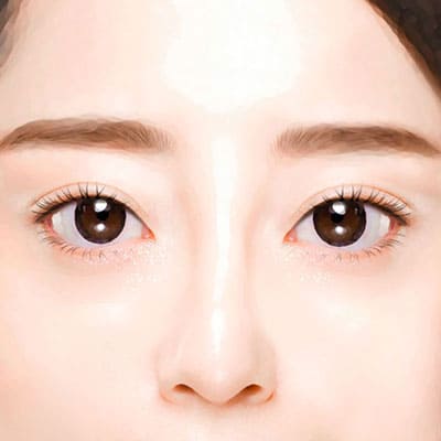 절개쌍꺼풀수술방법4완성