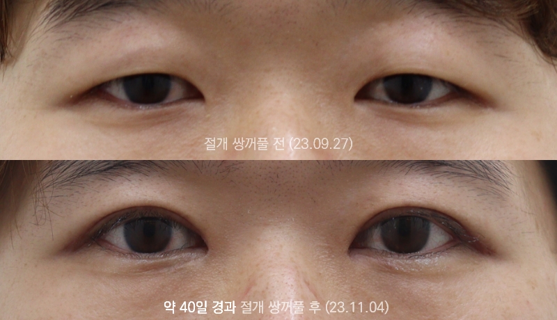 더올림성형외과 절개쌍꺼풀 40일경과