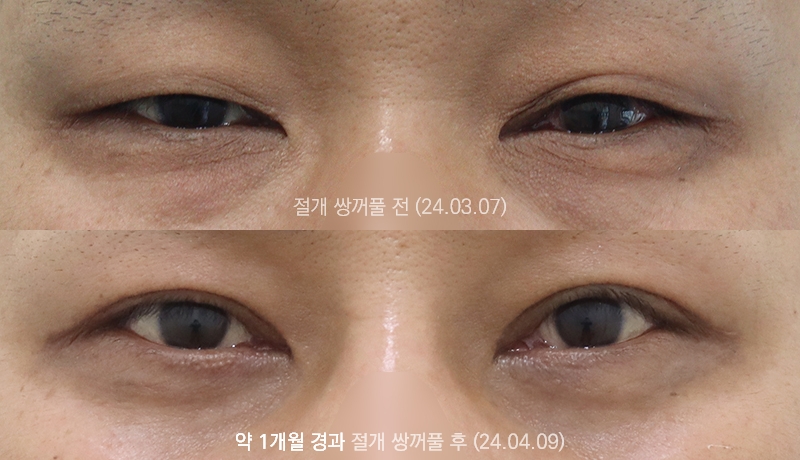 더올림성형외과 절개쌍꺼풀 1개원경과