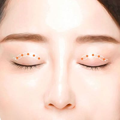 매몰쌍꺼풀수술방법3봉합