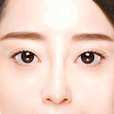 매몰쌍꺼풀수술방법4완성
