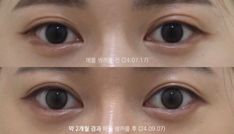더올림성형외과 매몰쌍꺼풀 2개월경과