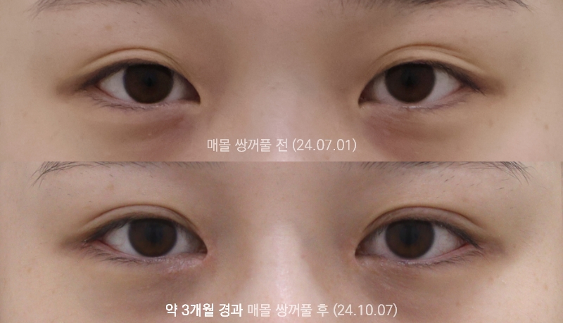 더올림성형외과 매몰쌍꺼풀 3개월경과