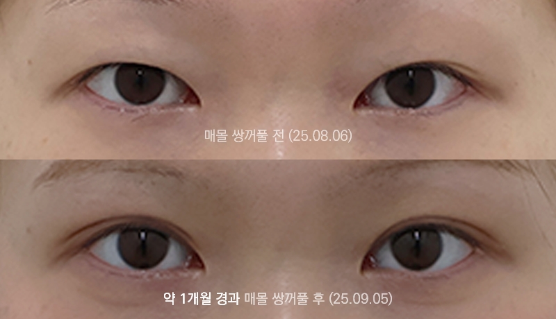 더올림성형외과 매몰쌍꺼풀 1개월경과