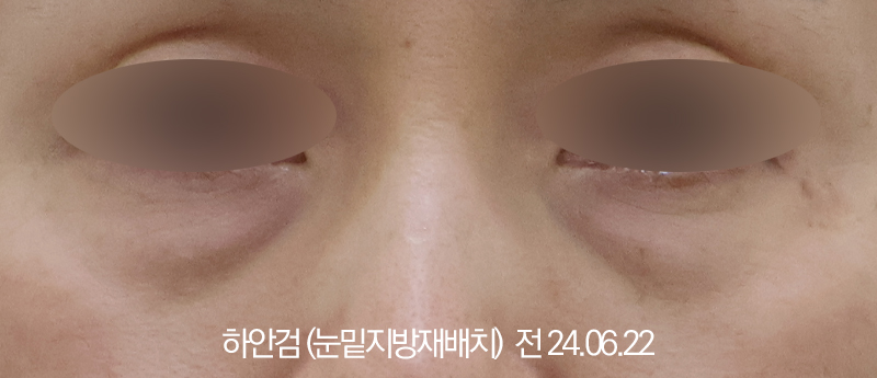 더올림성형외과 하안검수술 전사진