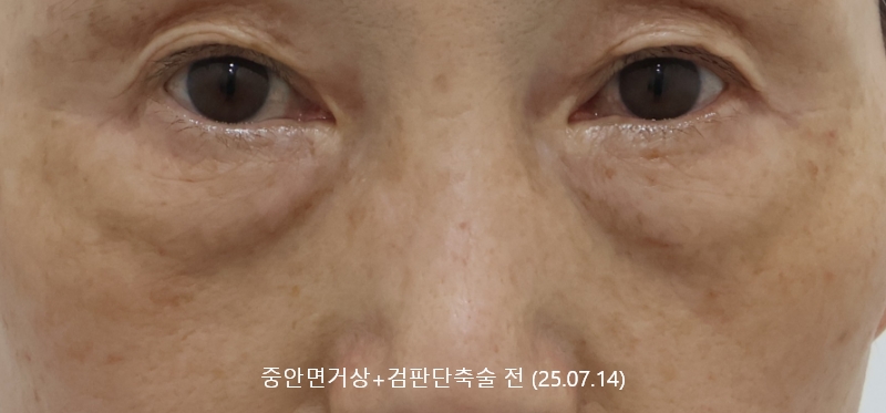 더올림성형외과 중안면거상 전사진