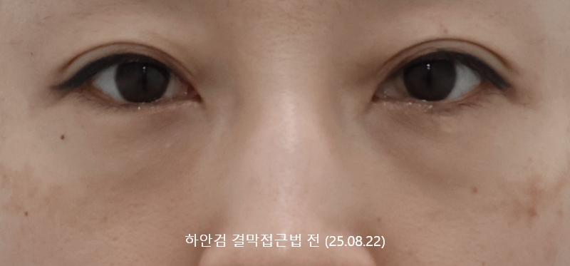 더올림성형외과 하안검결막 전사진