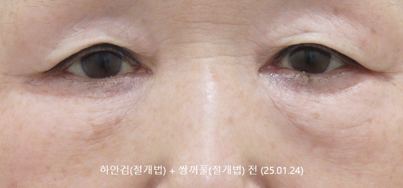 더올림성형외과 하안검절개 전사진