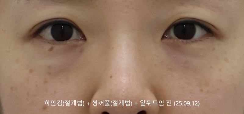 더올림성형외과 하안검절개 전사진