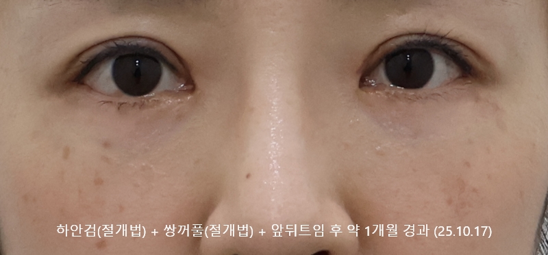 더올림성형외과 하안검절개 후사진 1개월경과