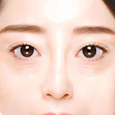 중년눈성형하안검수술방법1