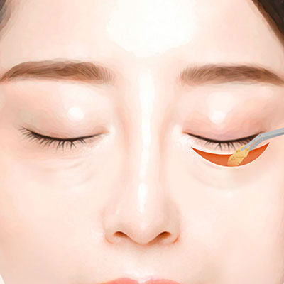 중년눈성형하안검수술방법2