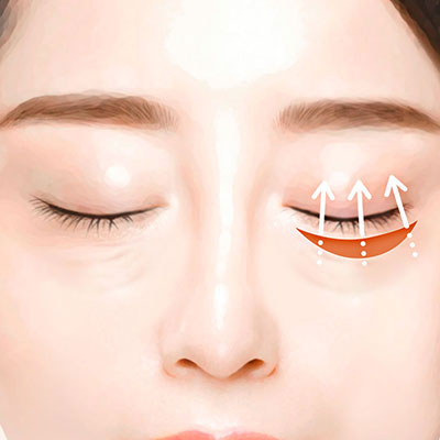 중년눈성형하안검수술방법3