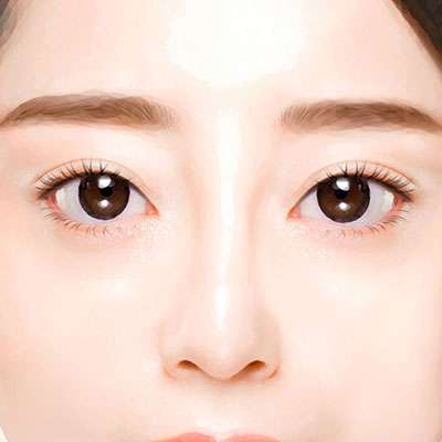 중년눈성형하안검수술방법4