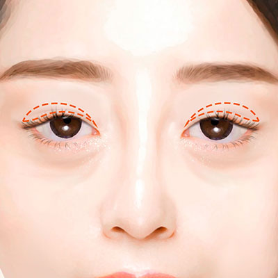 중년눈성형상안검수술방법1