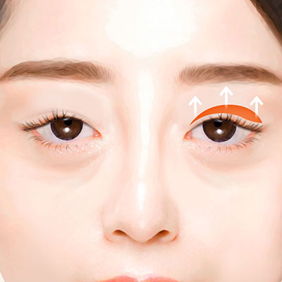 중년눈성형상안검수술방법3