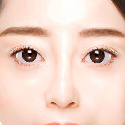 중년눈성형상안검수술방법4