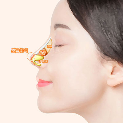 자려한코성형수술방법3