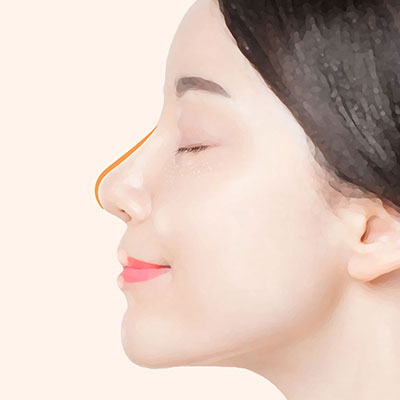 자려한코성형수술방법4
