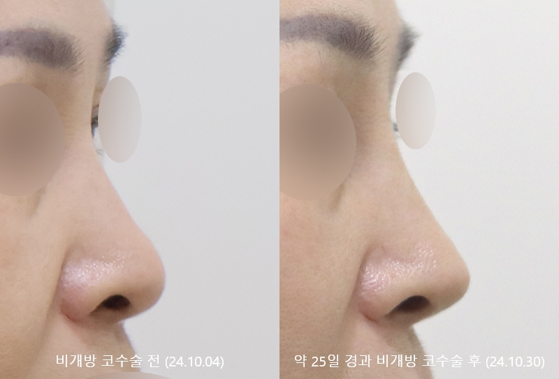 더올림성형외과 비개방코수술 25일경과