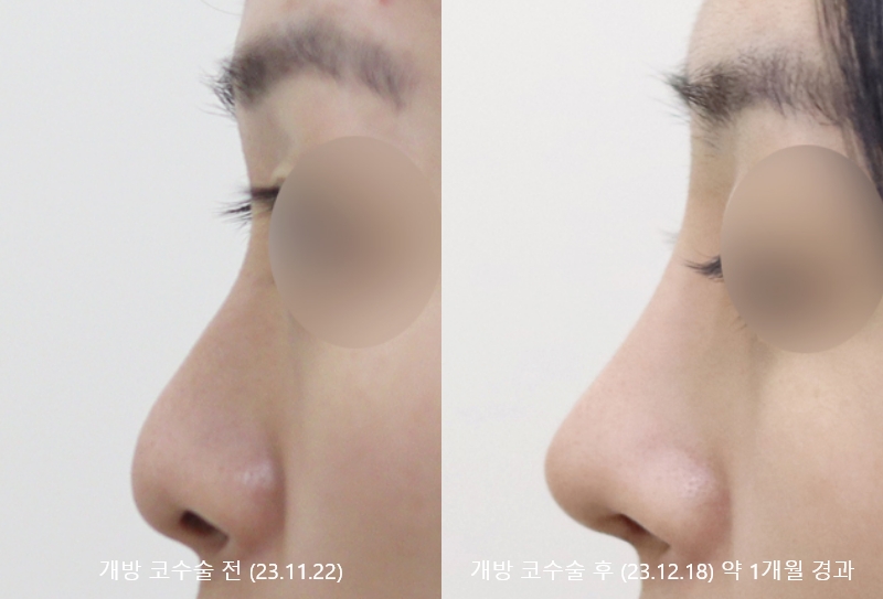 더올림성형외과 개방코수술 1개월경과