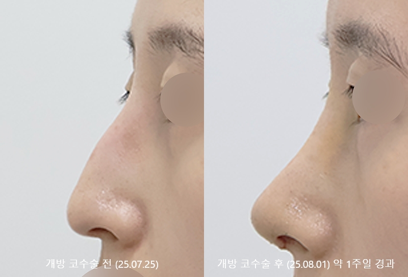 더올림성형외과 개방코수술 1주일경과