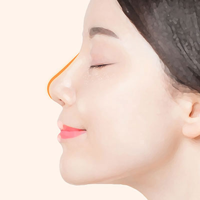 매부리코성형수술방법4